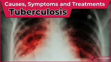 Tuberculosis article header – First Aid Article in 