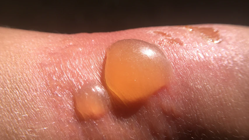 Sunburn blister